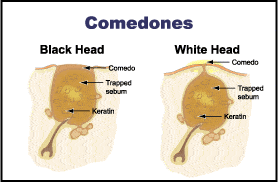 Comedo - Wikipedia