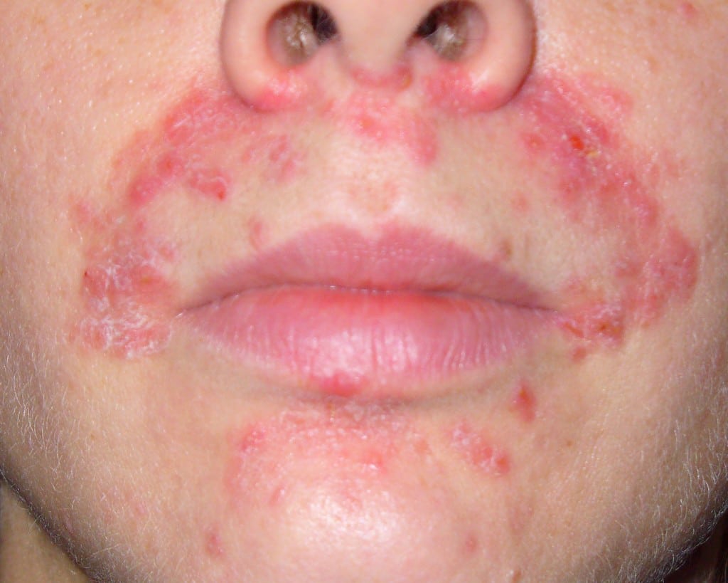 Dermatite périorale, présentation Dermite périorale, causes Dermite périorale Guide Acné