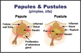 Nodular Acne, Whiteheads, Cystic Acne, Blackheads Treatment