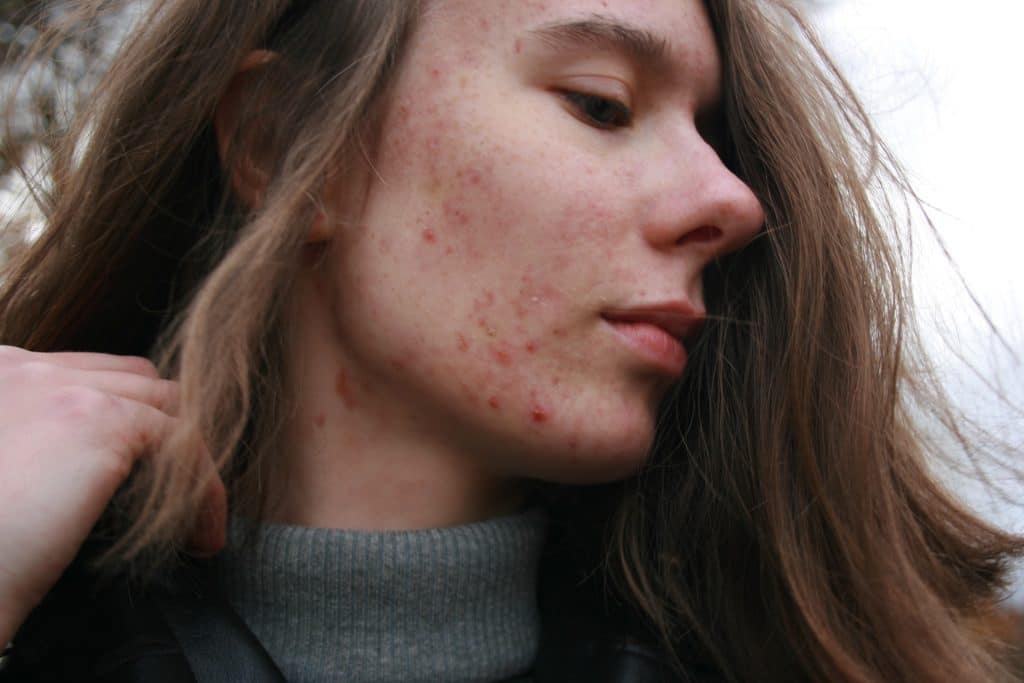 FAQ : Pourquoi a t-on des boutons d'acné ?